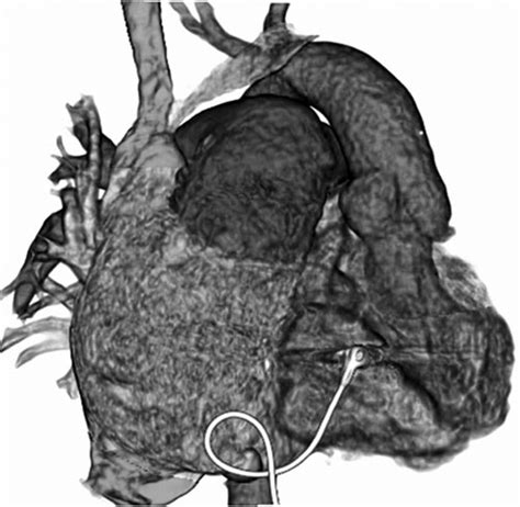 Preoperative Three Dimensional Computed Tomography Download