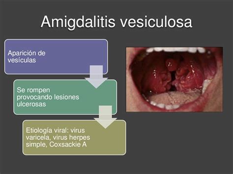 Amigdalitis