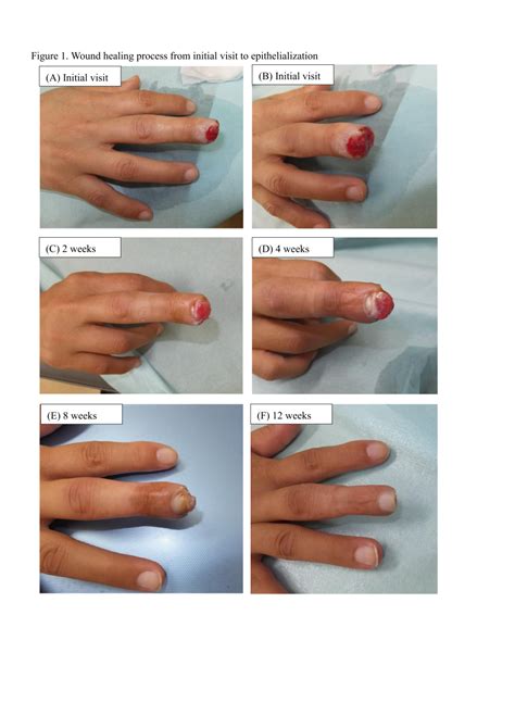 Fingertip Amputation Injury Managed Conservatively With Moist Wound