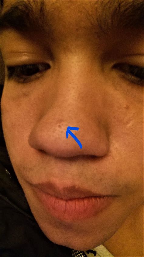 Skin Concerns I Popped A Pimple On My Nose Now I Have