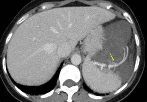 Retroperitoneal Haemorrhagic Cystic Lymphangioma Eurorad