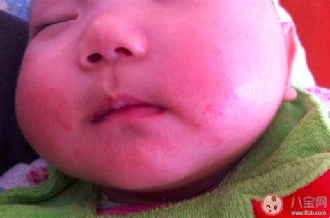 为什么宝宝会得口水疹 宝宝口水疹的护理及预防方法 八宝网