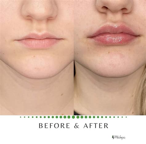 Lip Augmentation Before And After Lip Augmentation Botox Fillers Lip Fillers