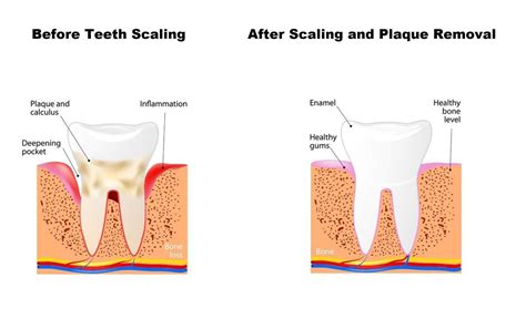 When Is Teeth Scaling Considered Urgent