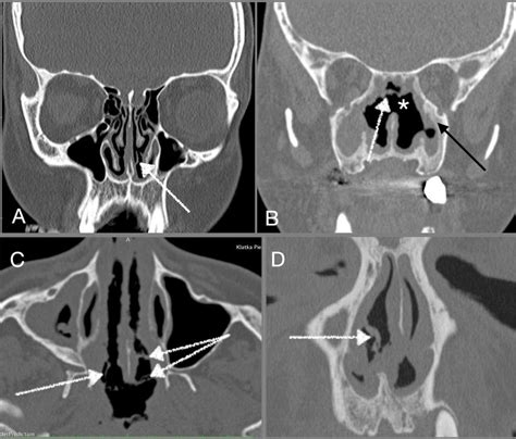 Paranasal Sinus Computed Tomography Scans Of Patients With