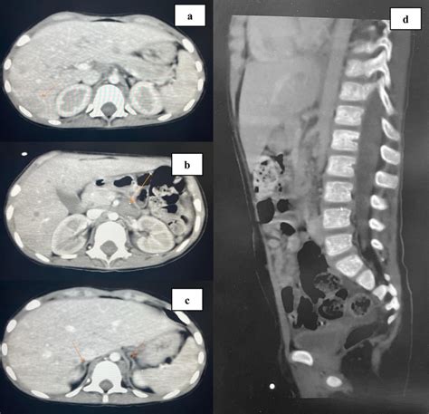 A Abdominopelvic Ct Axial Section Showing Multiple Hepatic