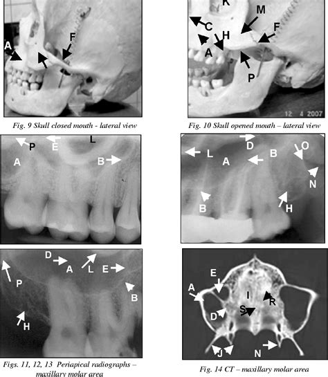 Figure 14 From Normal Radiographic Anatomy Maxillary Lateral Area