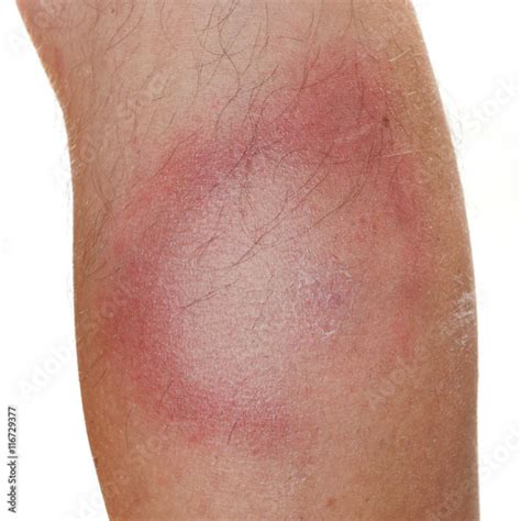 An Erythema Migrans Rash Often Seen In The Early Stage Of Lyme Disease