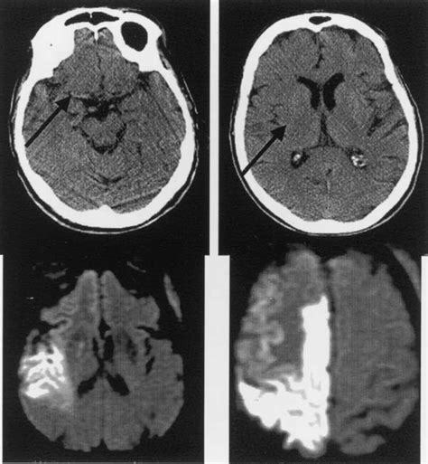 Acute Ischemic Stroke Ct And Diffusion Weighted Mr Download