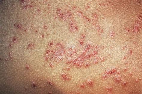 Early Results Indicate Prolonged Improvements In Atopic Dermatitis With