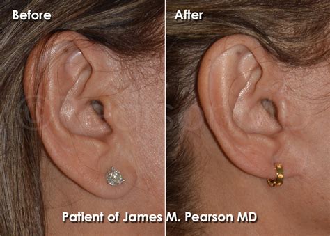 Earlobe Reduction Photos Before And After Dr James Pearson Facial