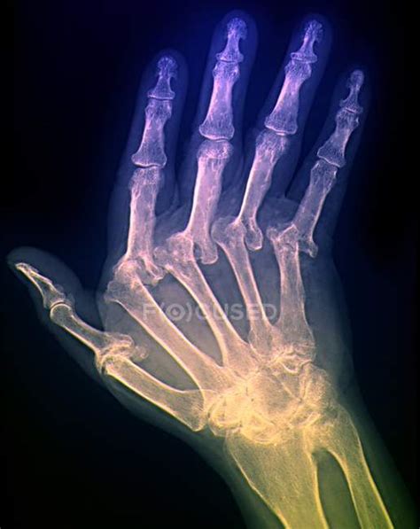 Arthritic Hand Anatomy — Pain Joint Stock Photo 160564318