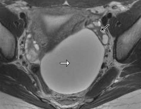 Mri Of Tumors And Tumor Mimics In The Female Pelvis Anatomic Pelvic