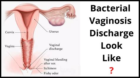 Bacterial Vaginosis Discharge Look Like Here Is It