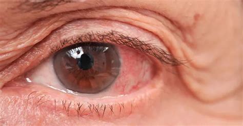4 Horrible Eye Conditions Due To Diabetes Marham