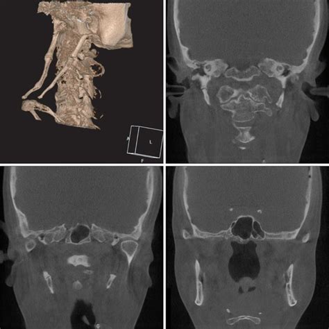 Panoramic View After Surgery Shows That Most Of Both Calcified
