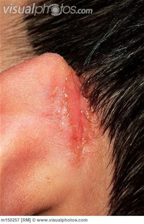 Eczema Behind Ear Ear Rash Eczema Pinterest Ears And Health