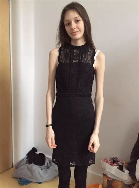 Irish Teen Reveals Her Anorexia Would Have Killed Her If She Didn T Travel To The Uk For