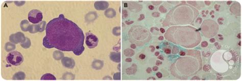 Severe Acute Anemia Attributable To Concomitant Occurrence Of Aiha With