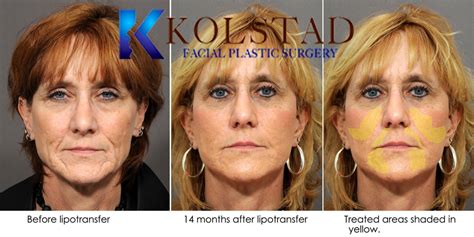Dr Kolstad San Diego Facial Plastic Surgeon