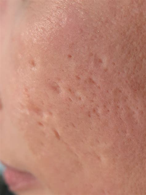 Advances In Understanding Atrophic Acne Scarring And The
