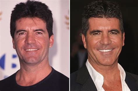 Simon Cowell Before And After Plastic Surgery 26 Celebrity Plastic