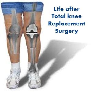 Life After Total Knee Replacement Surgery Dr Amyn Rajani Blog