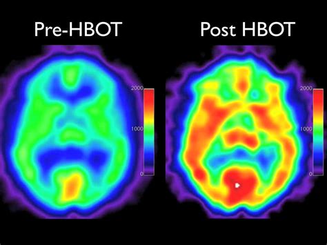 Spect Scans Use In Detecting Traumatic Brain Injuries