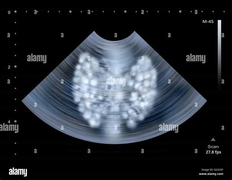 Ultrasound Scan Of Human Thyroid Gland Illustration Stock Photo Alamy
