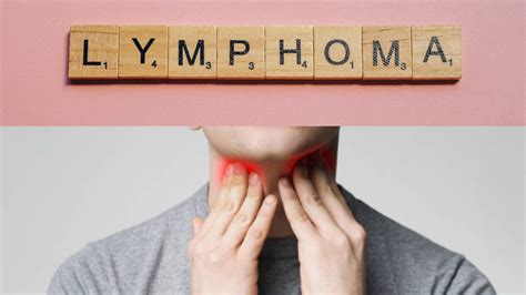 9 Warning Signs Of Hodgkins And Non Lymphoma Hodgkins Lymphoma