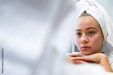 Acne A Sad Teenage Girl Problematic Skin In Adolescents Stock Photo