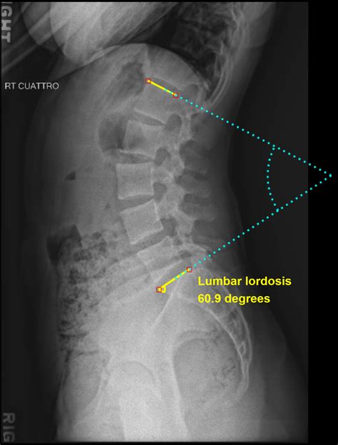Lumbosacral Spine Plain Radiographs Radiology Key