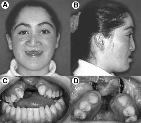 Maxillary Anterior Segmental Advancement Of Hypoplastic Maxilla In