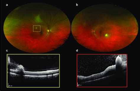 Right A And Left B Ultra Wide Field Fundus Photos Of A Patient With