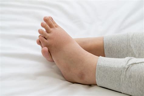 Top Causes Of Foot And Ankle Swelling Advanced Bone And Joint