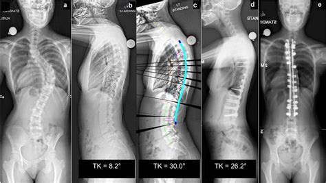 Radiographs Of A 13 Year Old Patient With Adolescent Idiopathic Download Scientific Diagram