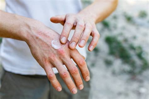 Home Remedies For Severely Dry Cracked Hands Mother Earth News