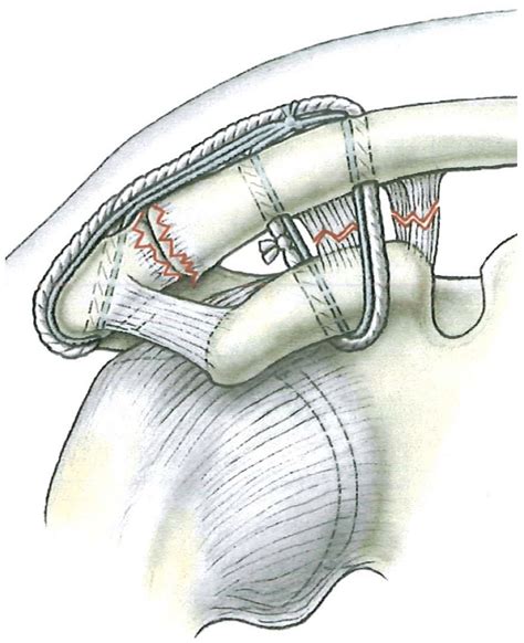 Final Configuration Of The Bipod Acromioclavicular Repair Is Shown The