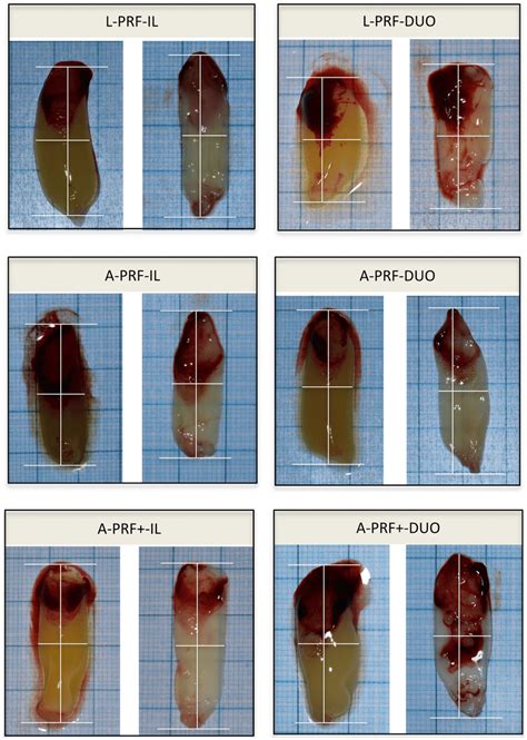 Standardized Pictures And Measurements Of The Clots And Membranes The