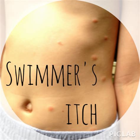 6 Tips To Prevent And Treat Swimmers Itch Meal Tickets Swimmers Itch Swimmer Itch