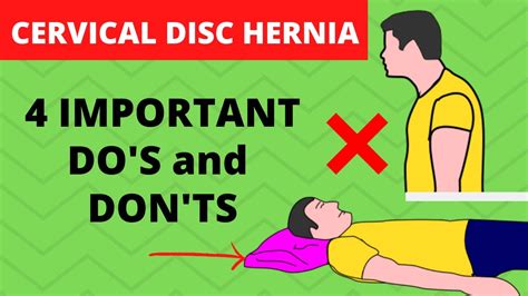 Cervical Herniated Disc Exercises To Avoid Sleeping Position