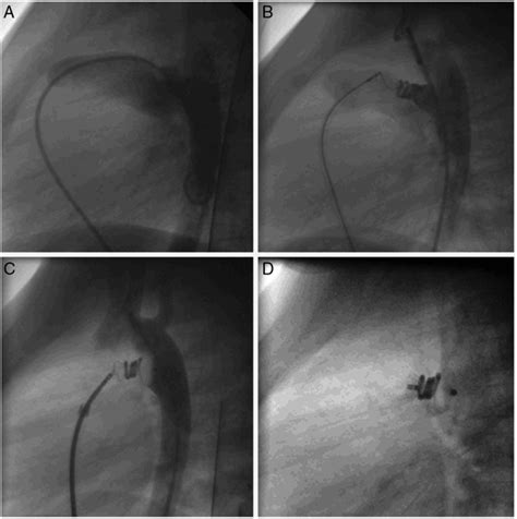 Amplatzer Duct Occluder For Treatment Of Displaced Pda Coil Induced