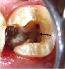 Endodontic Management Of Elusive Middle Mesial Canal In Mandibular
