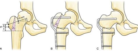 Femoral Osteotomy Plastic Surgery Key