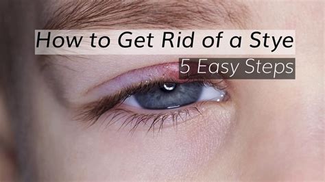 Eye Stye Treatment How To Get Rid Of A Stye In 5 Steps Youtube