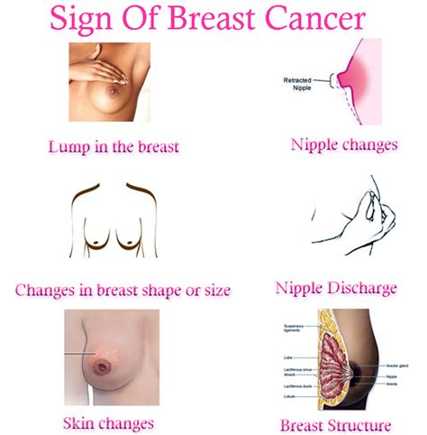 Women may feel discomfort and pain as the cancer grows and spreads in the breast. Breast Cancer Pictures: Sign Of Breast Cancer
