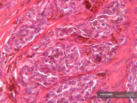 Microscope View Of Malignant Melanoma — Histology High Angle View