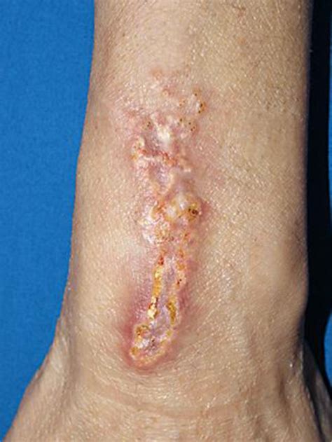 Photograph Of The Skin Lesion Showing An Indurated Plaque Measuring 13