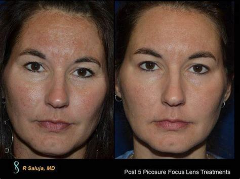 Melasma Treatment Before And After Charlotte Huntersville Nc Saluja