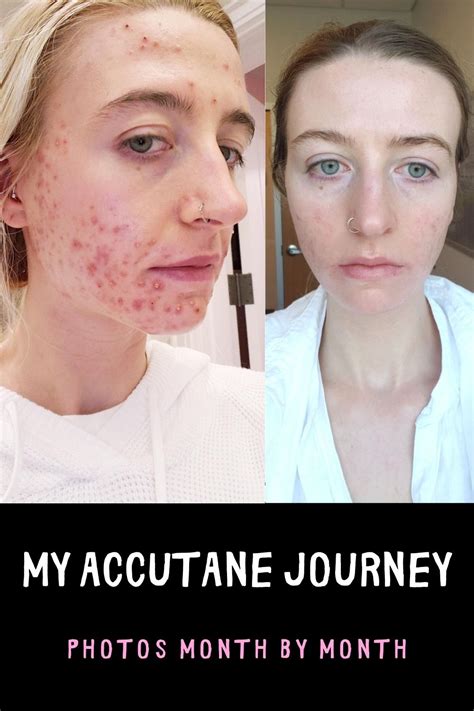 MY ACCUTANE JOURNEY I Before & After Photos of Acne & Clear Skin | Dry